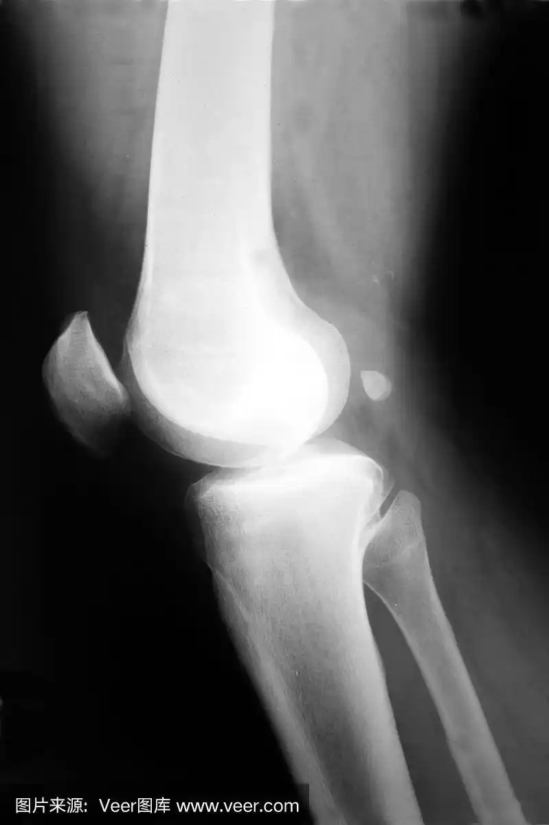 膝,x光,髌骨,射线成像,腿骨