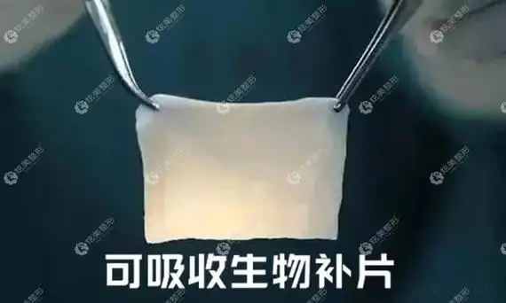 可以用生物补片填充奥美定取出后的塌陷