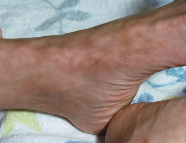 网状青斑 (13)_有来医生