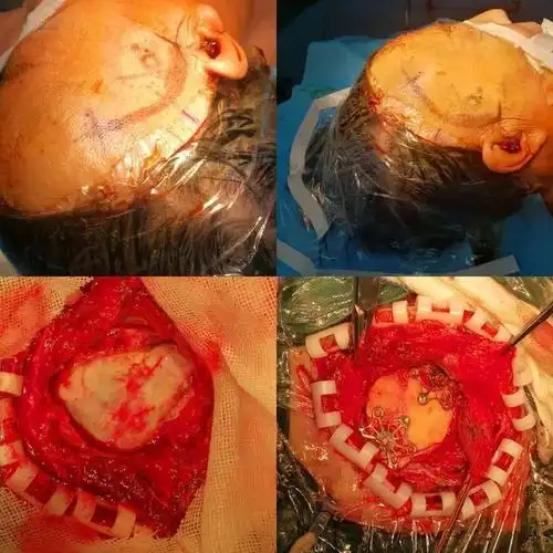 正海妙术视界孙怀宇主任锁孔入路显微外科手术治疗大脑中动脉动脉瘤