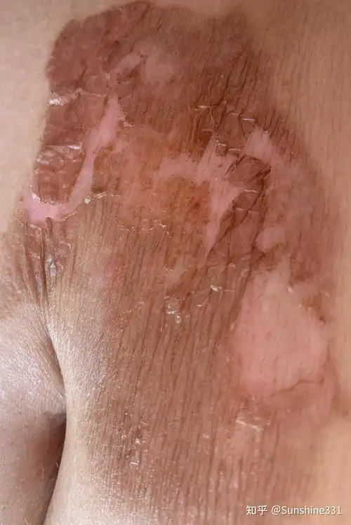 二度烫伤恢复过程记录