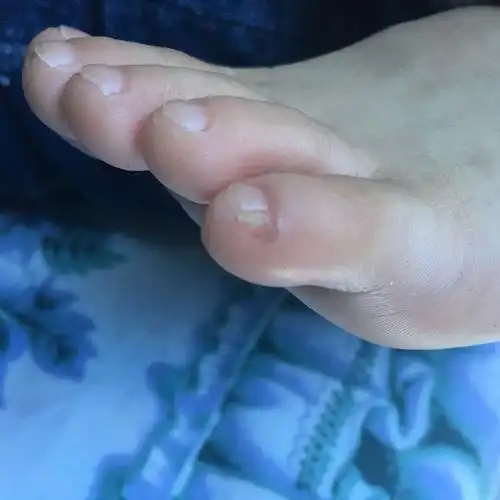 为什么孩子小脚丫的指甲长成这样?怎么回事?因为什么原因才会这样
