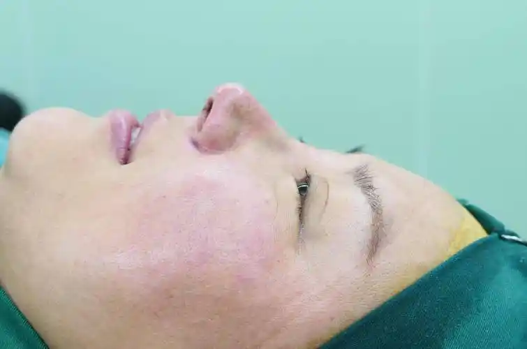 有图有真相:l型硅胶鼻假体,7年后取出"长"这样!_鼻尖_软骨_鼻子