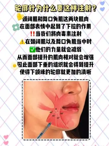 97瘦脸针为什么要和轮廓提升一起打?