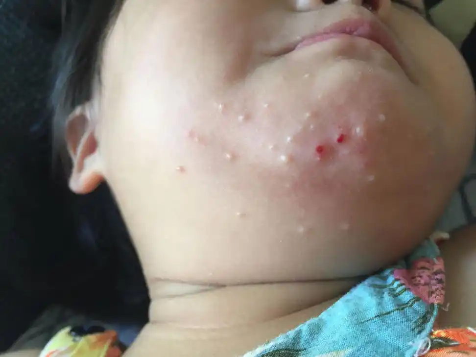 小孩下巴长的是什么