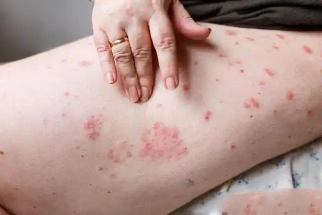 怎么会有牛皮癣图片