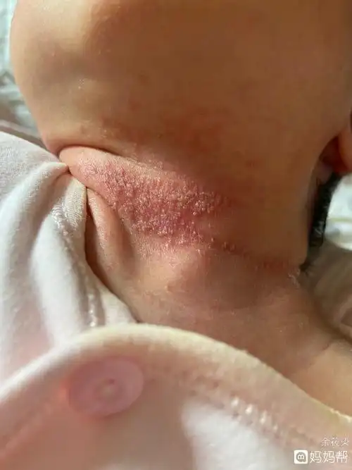 女宝宝淹了屁股怎么办 女宝宝淹了屁股怎么办图片每