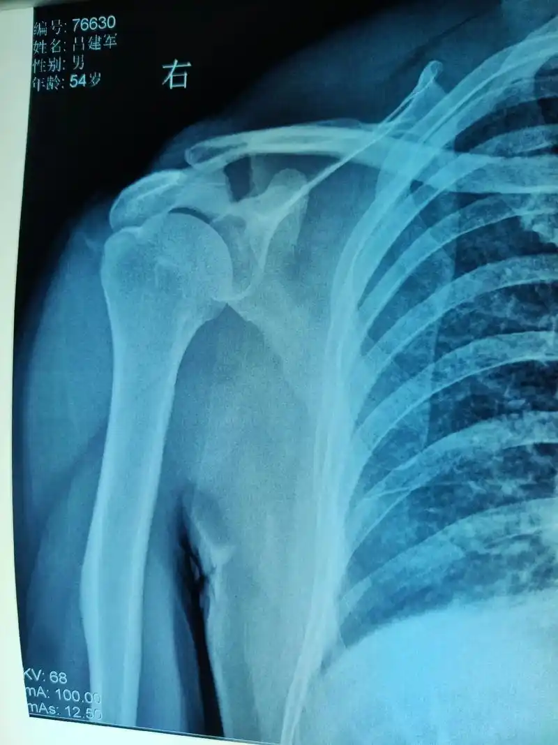 医学科普 #肩峰骨折# - 抖音
