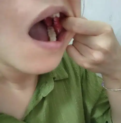 口腔里长了两颗黑色的泡,这是什么东西啊?