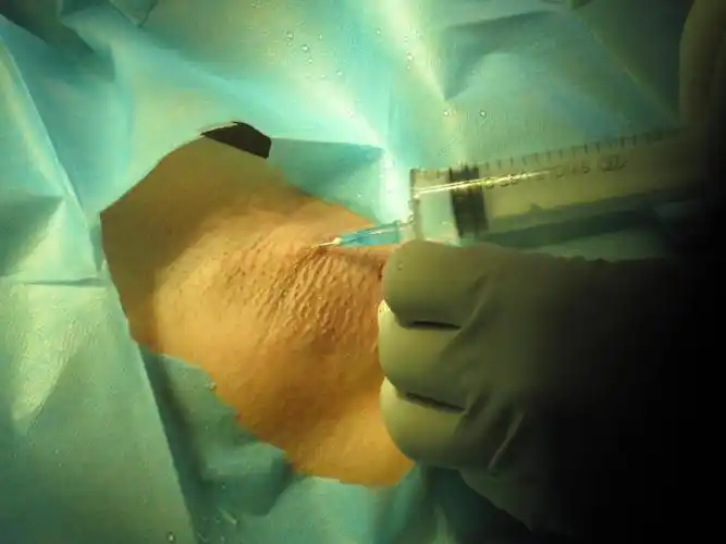 改良腋臭大汗腺切除术