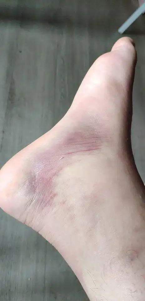 脚扭成这样怎么办