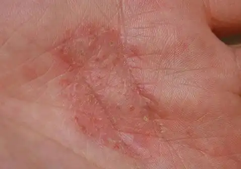 手部手上长湿疹的图片大全:手背湿疹图片,手掌湿疹图片