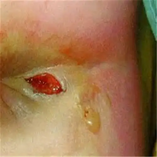 肛周脓肿