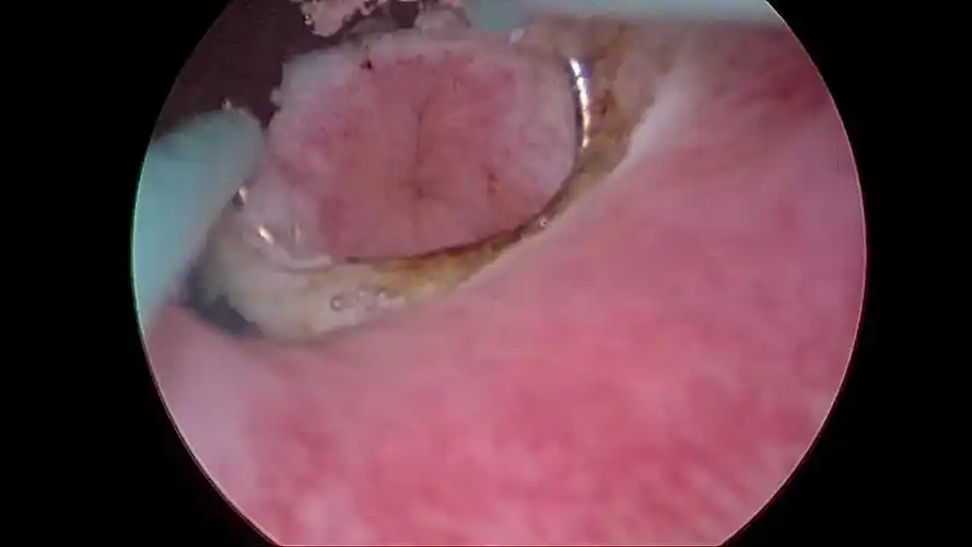 输尿管开口囊肿的微创治疗