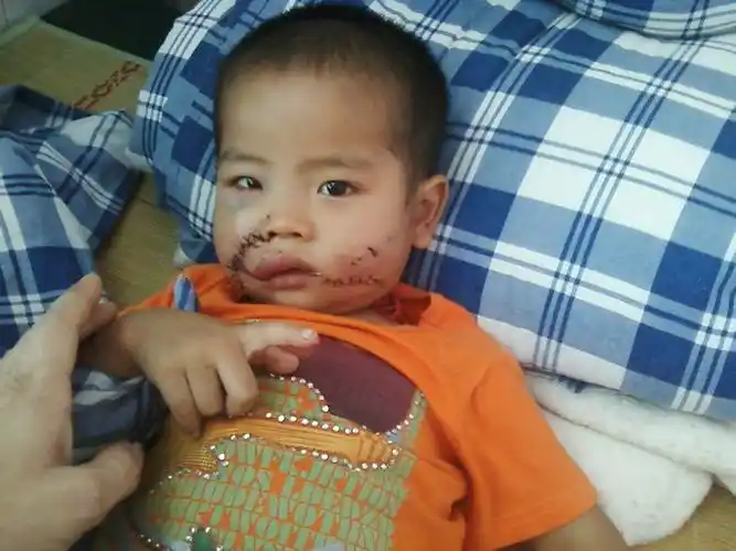 小狗咬人出血了怎么办