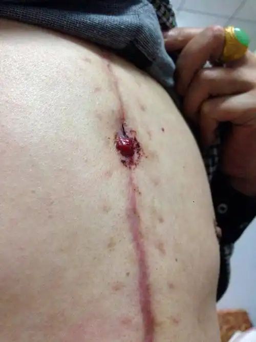 老爸之前做了手术 伤口愈合几个月了 前几天有一小块地方被我爸不小心