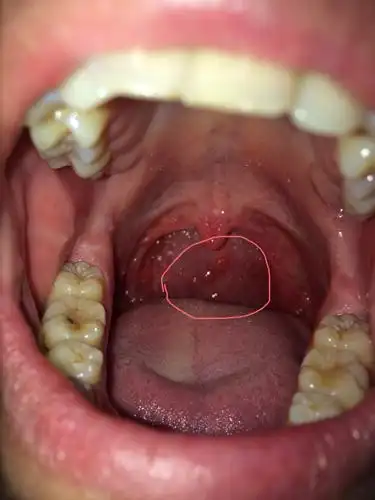 我做过扁桃体手术,我发现我咽道壁上长满水泡一样