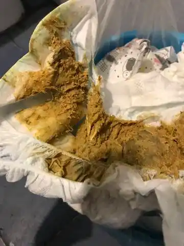 宝宝最近几天很烦躁,晚上睡觉闭着眼睛哭闹,翻来覆去频繁,今天大便