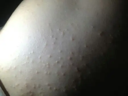 宝宝背上大腿手臂长这些,不痒不痛,谢谢.