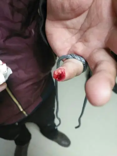 一位刀砍伤病人    完全离断伤    病号   刘德亮    男   29岁