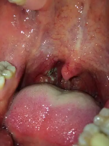 扁导体左右两侧突然出现白色东西 请问这是发炎吗会不会癌变