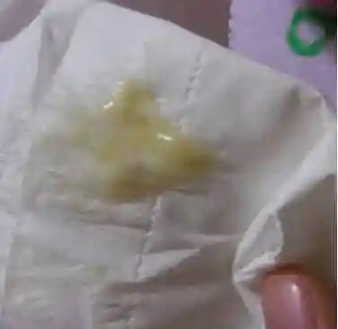 很粘稠又有点淡黄色,这可能是初期慢性宫颈炎唯一的症状,如果出现白带