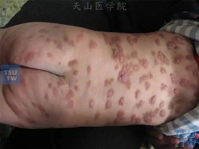 色素性荨麻疹(urticaria pigmentosa)症状表现 - 皮肤病学 - 天山医学