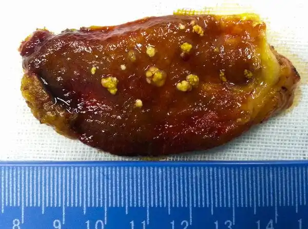 胆囊息肉长什么样?