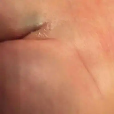 宝宝出生四十六天,今天发现小孩屁股沟线分叉,在分叉两端有两个小凹陷