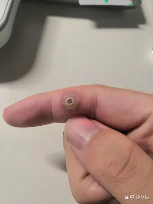 液氮冷冻治疗寻常疣记录帖ー