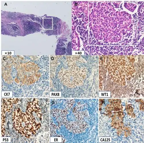 惰性t淋巴母细胞增殖性疾病一例