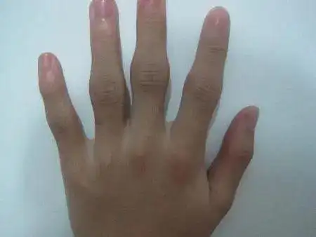 尿酸盐结晶绿色小结晶当大量的痛风石形成时,双能ct是这样的.