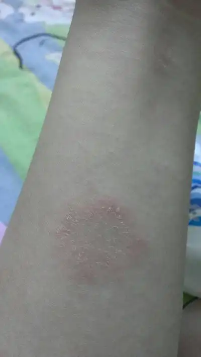 宝宝身上长癣图片 (11)