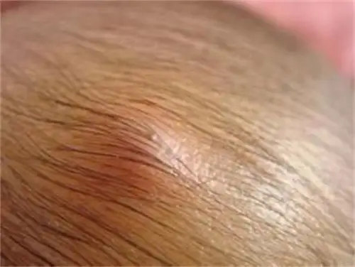 疖溃烂化脓的图片