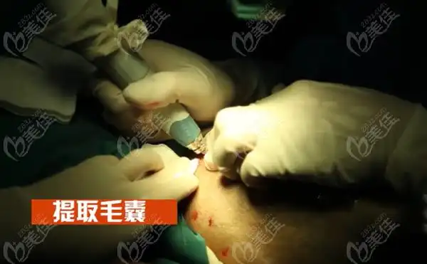 真实的植发全过程图片多图这组发际线成功植发的例子来自南宁大麦微针