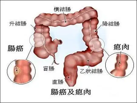 排便如果出现这两个"现象",劝你及时做个肠检!