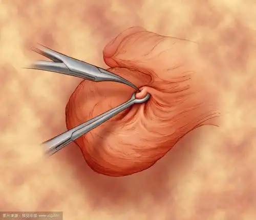 想避孕其实很简单,做个输精管结扎就可以!