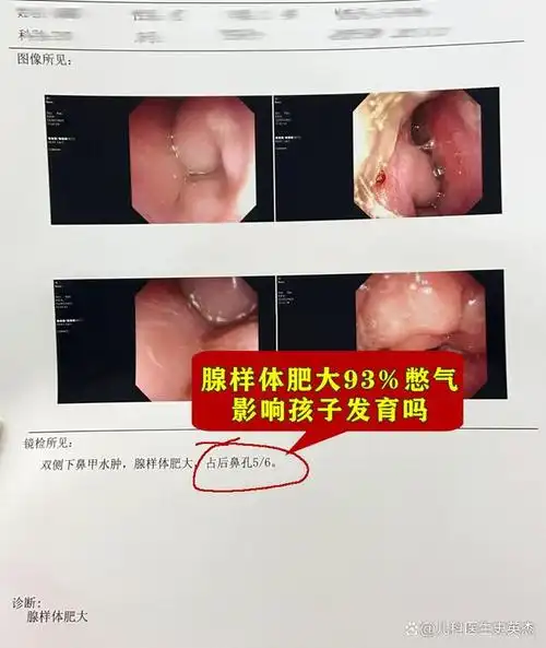 病情描述:5岁孩子, 做了鼻内镜堵塞了93%,最近已经堵到影响呼吸了半夜