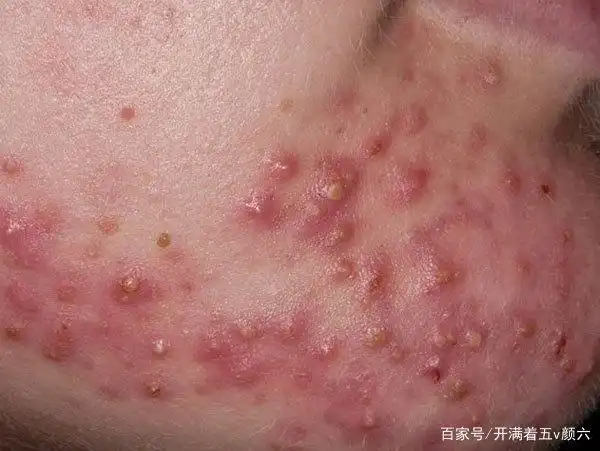 囊肿型痘痘怎么消下去?sor索尔祛痘护肤分享