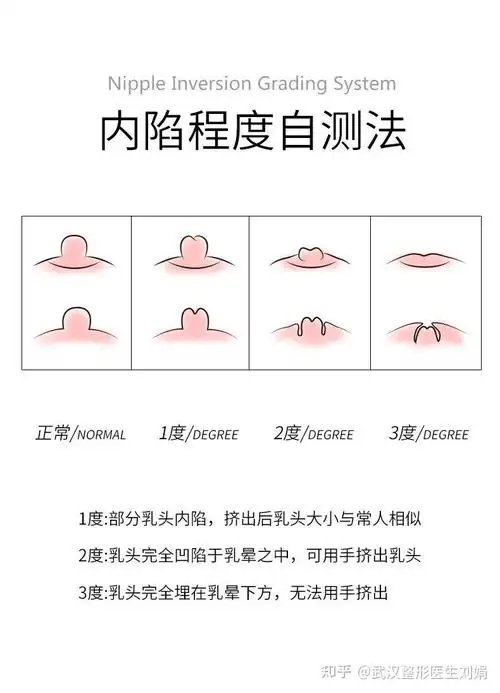 轻者仅表现为乳头较平或回缩,受刺激后可以凸起