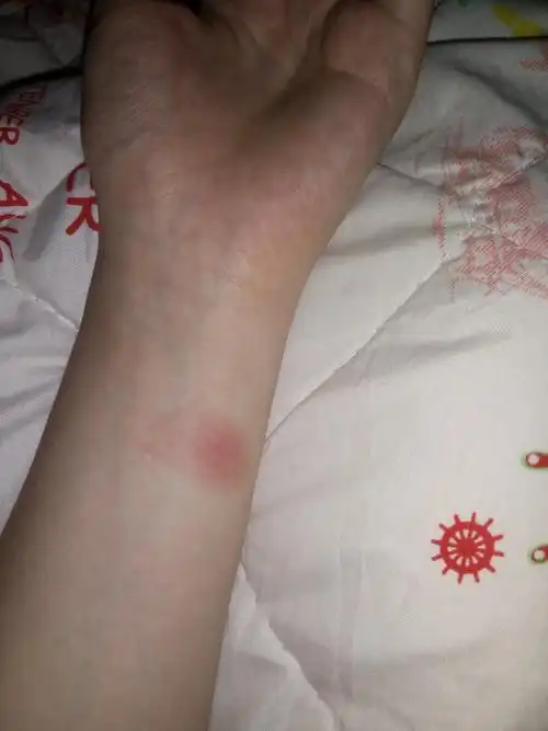 ppd(ppd试验结果阳性怎么办)