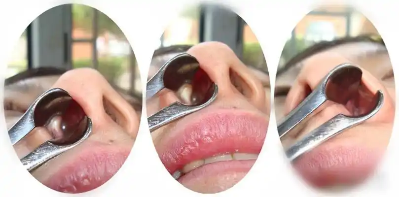 鼻窦炎症状图片 (44)