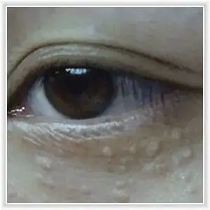 为什么南方人长汗管瘤