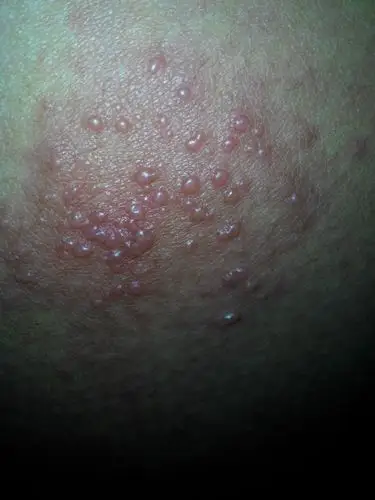 第一张是2天前的,现在在擦复方醋酸地塞米松乳膏.