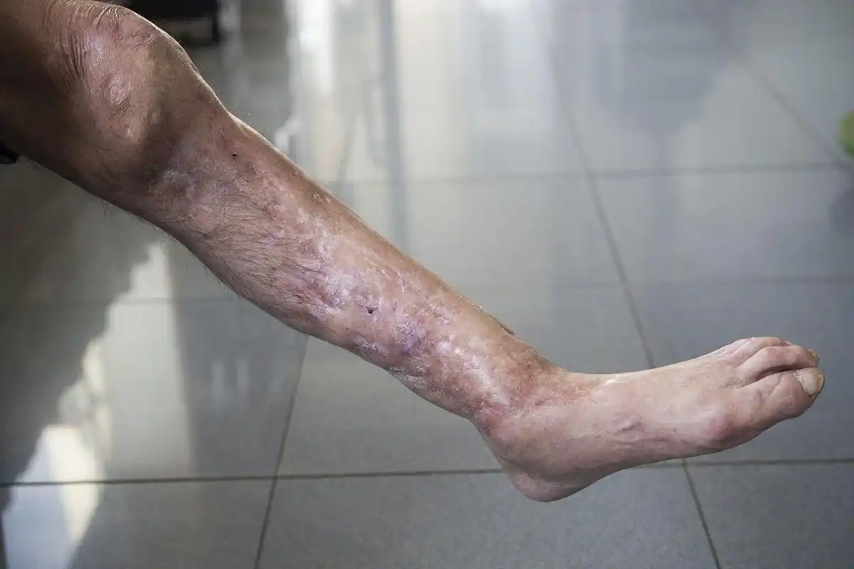 血管炎是一种自身免疫性疾病,患有此疾病后可能会出现皮肤结节,启肤