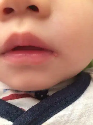 宝宝嘴角长了一个这样的疙瘩,大家看看是什么呢!这几天发烧,37.5左右!