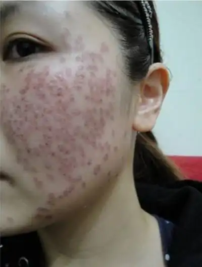 激光祛斑后反黑图片6