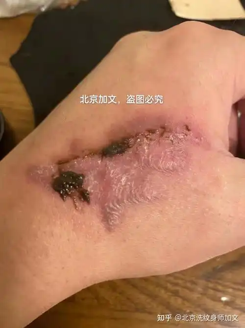 洗纹身留下的伤疤治疗好的效果全过程