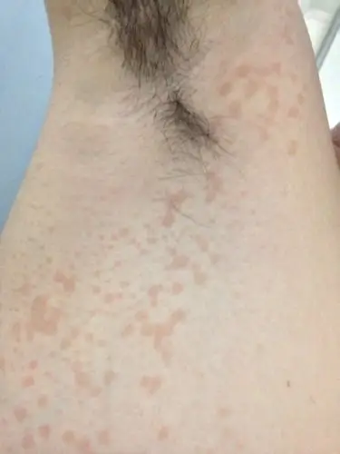 这是长的啥,右边腋窝下,红色的,不突出,不痛不痒