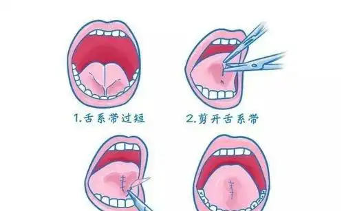 什么是舌系带过短宝宝何时适合进行舌系带手术